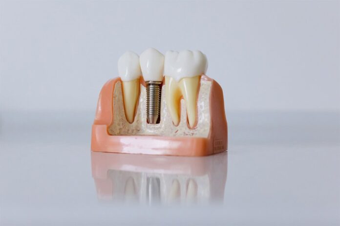 top_6_clinici_de_implant_dentar_n_bucureti_n_2026_dental_premier_i_alte_opiuni__luate_n_considerare